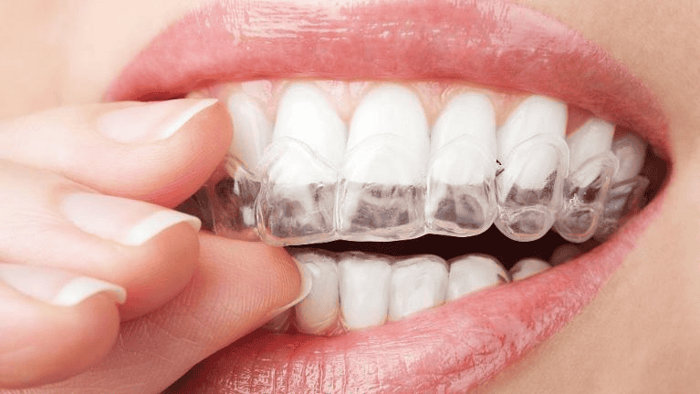 Picture showing a clear aligner on the teeth.